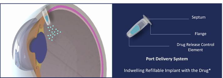 Port Delivery System (PDS) for maintaining therapeutic drug concentration levels. 